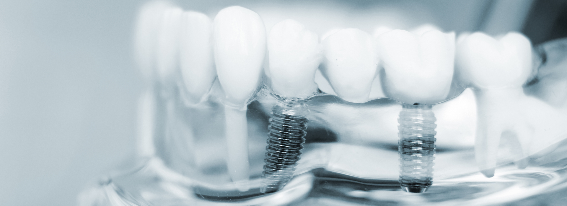 Dental Implants Short Hills